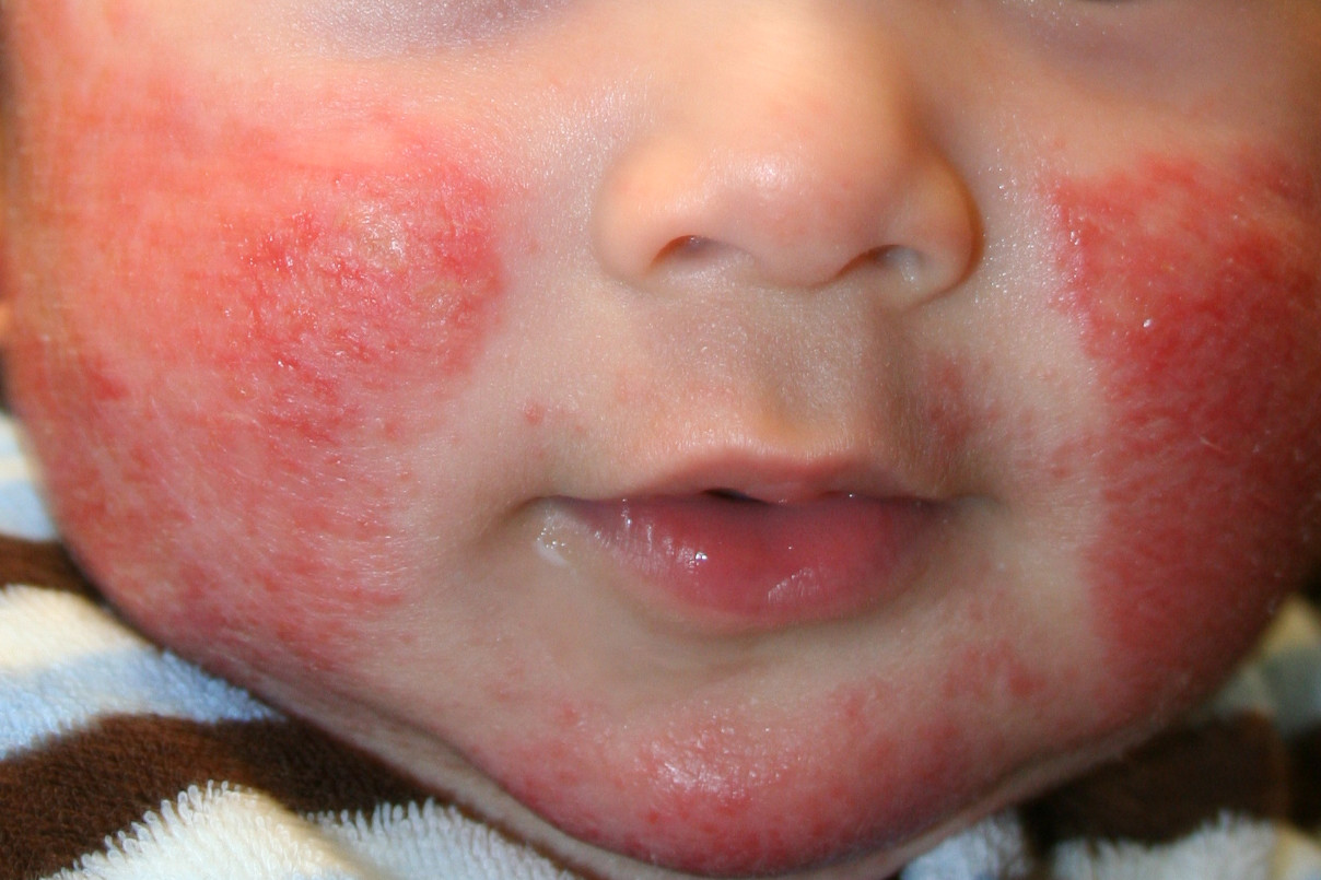 Eczema (Atopic Dermatitis) Causes, Symptoms, Treatment