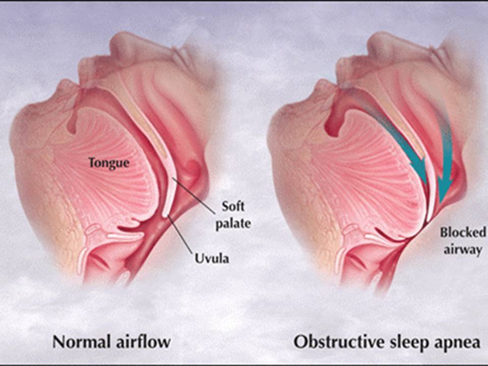 Teen Sleep Apnea Sleep Apnea 36