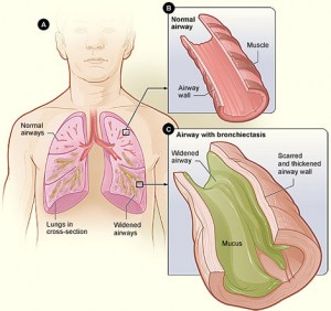 what is bronchiectasis