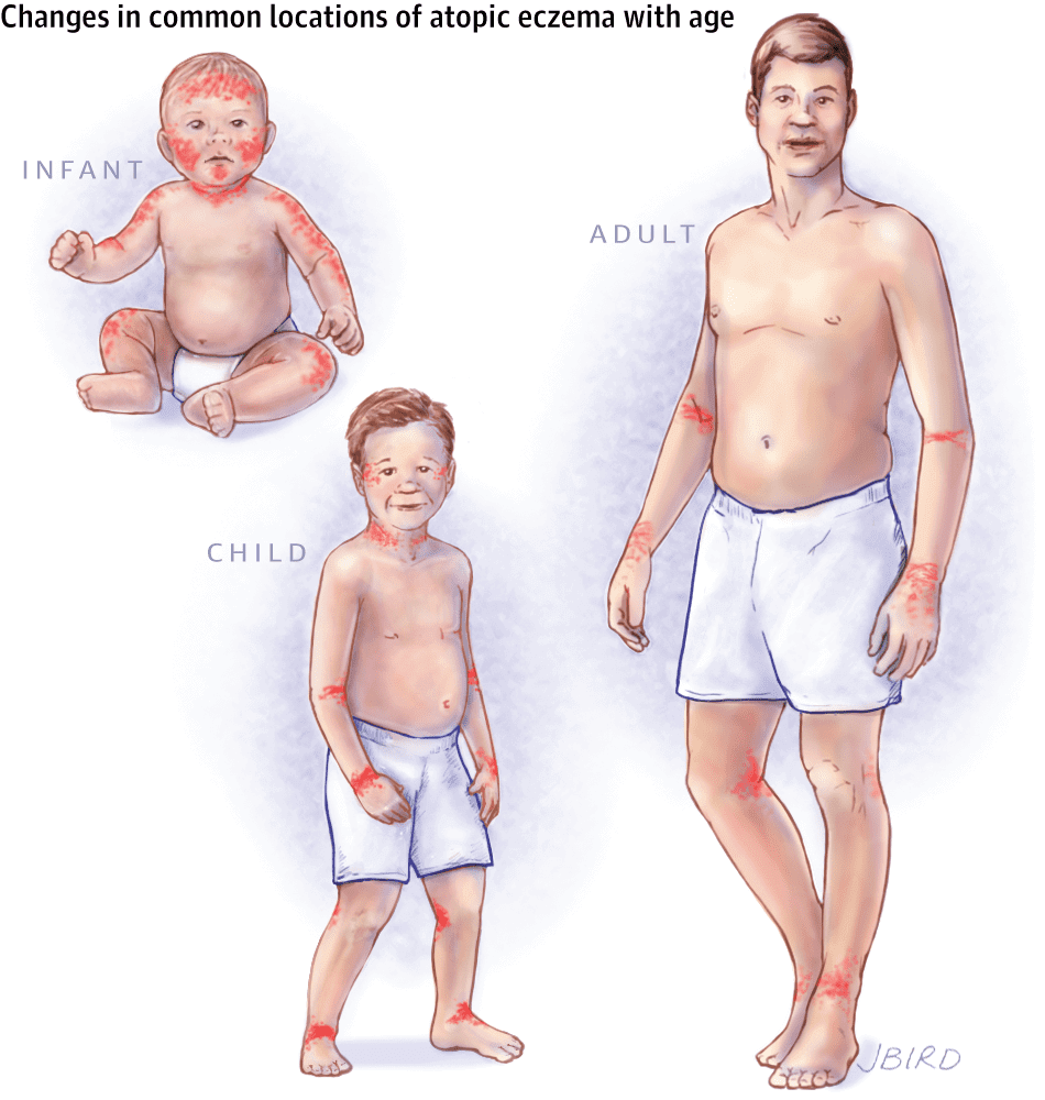 eczema changes with age